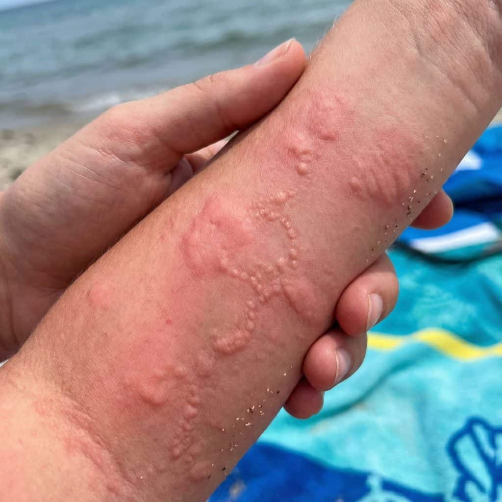 붉게 부어오르고 통증이 느껴질 듯한 촉촉한 물집이 피부에 밀집된 모습이다.