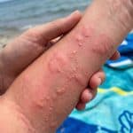 해파리 쏘였을 때 식초 사용 여부: 맹독성 해파리와 일반 해파리 구분